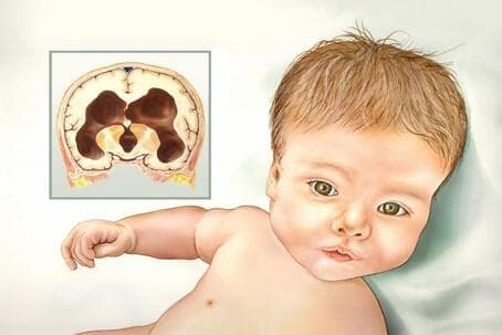Гидроцефалия у ребенка фото