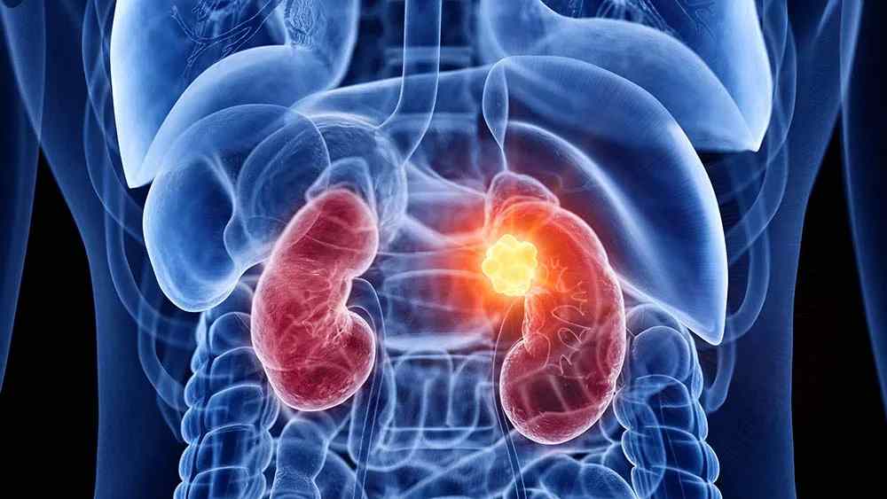 Нефробластома