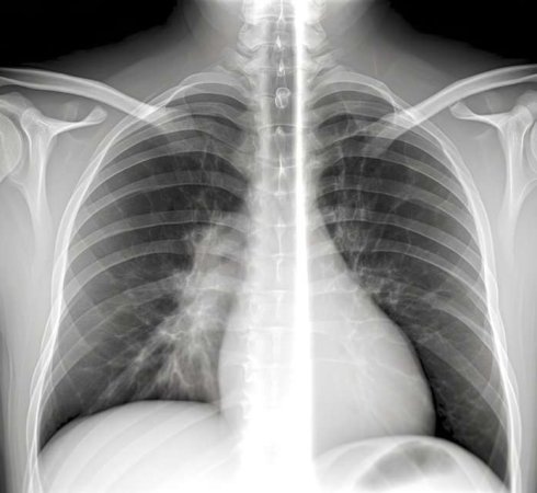 Саркома Юинга