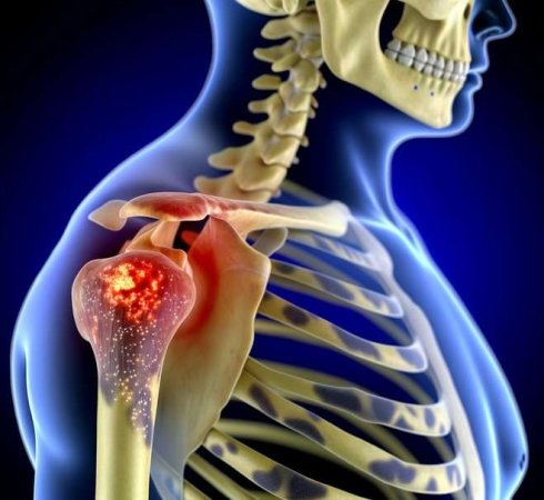 Остеосаркома