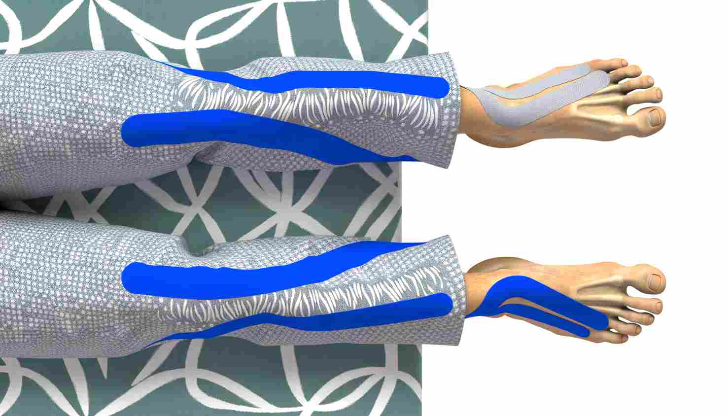 Тейпирование при ДЦП