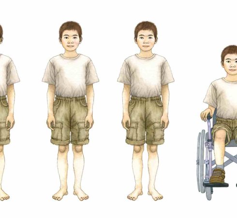 Классификация ДЦП