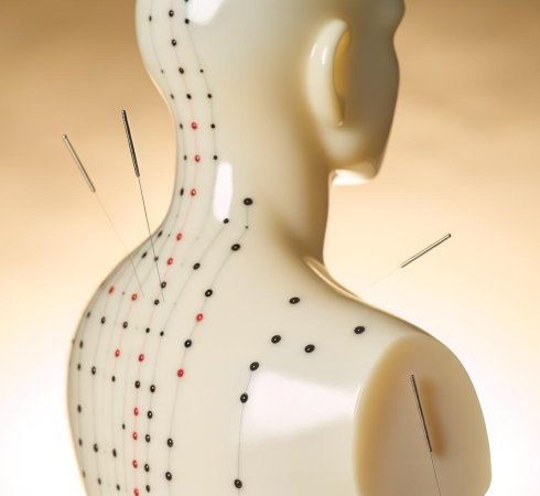 Иглорефлексотерапия