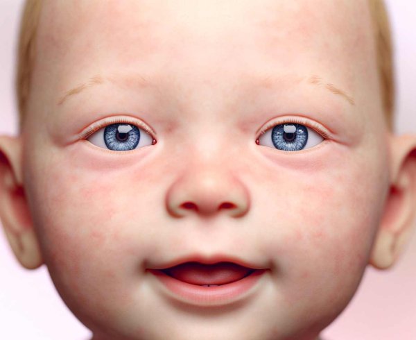 Нистагм: виды, симптомы, лечение