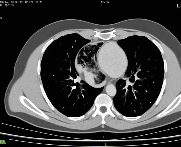 Лечение нейробластомы