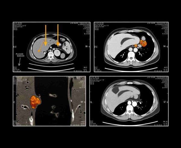 Нейробластома забрюшинного пространства у детей